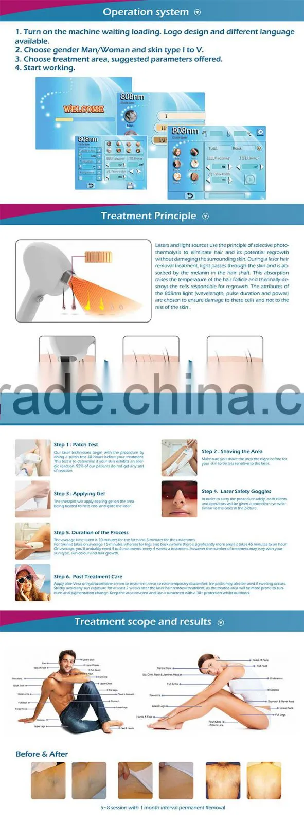 2016 best effective 600W output ingrown laser hair removal machine with multi-color choice