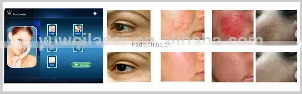Fractional RF freckle remova Machine with 64 matrix points for salon , clinic
