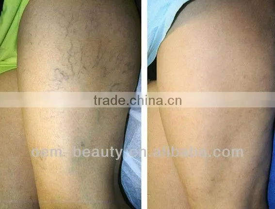 Most salable infrared laser hair removal machine for spider vein/ toenail fungus treatment