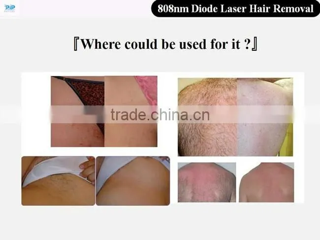 DLP7 808 diode Laser hair removal machine diode POP- DL7 808nm diode laser machine for POPIPL