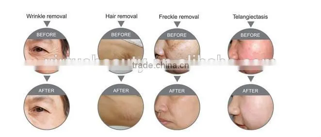 professional alexandrite laser hair removal machine price