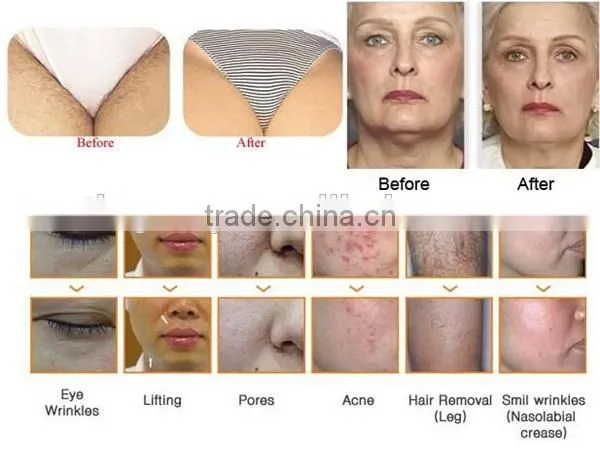 IPL intense pulsed light hair removal system