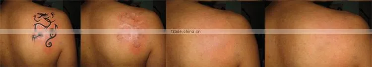 tattoo removal machine all colors small ultrasound machine