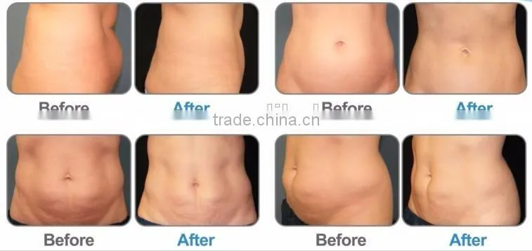 Home Use Suppliers Cool Tech Fat Freezing Machine For Fat Burning