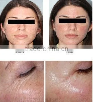 Stretch Mark Removal Micro Needle Fractional RF Radio Frequency Beauty Equipment