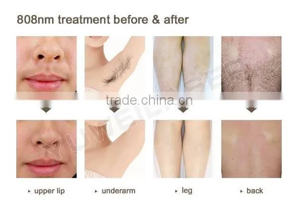 2016 Hot 808nm diode laser permanent hair removal/