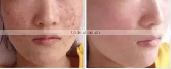 Advanced Intense Pulsed Light IPL Photo Rejuvenation Hair Removal Equipment