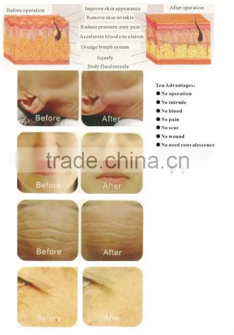 TM-RF02 skin tighten rf type beauty device