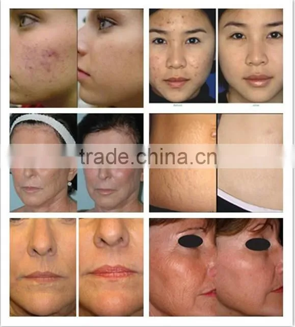 RF skin tightening machine skin whitening products best face lifting machine