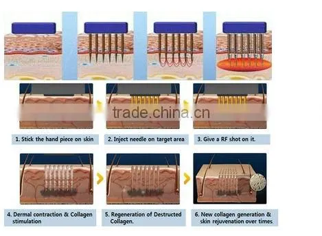 Top performance!!!! microneedle skin treatment portable fractional rf