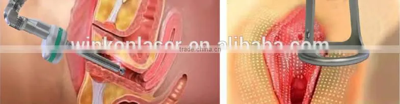 fractional laser co2 / co2 laser tube price