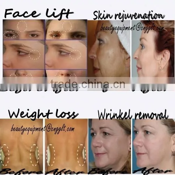 Hith quality CE approved skin tightning rf face lift machine