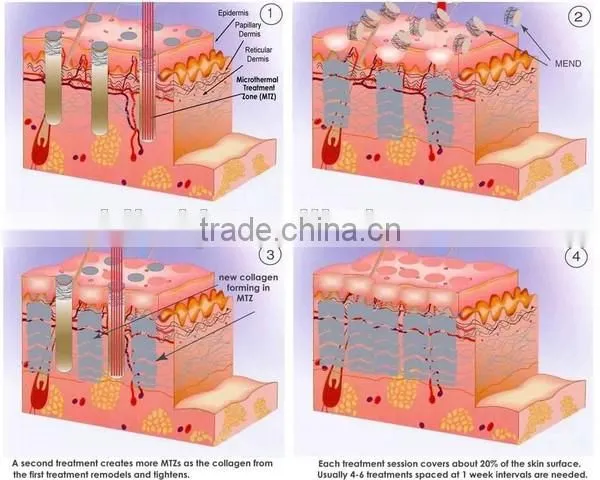 2015 hot selling!! rf co2 fractional laser machine/Co2 fraccional laser