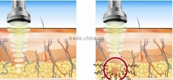 cavitation+RF