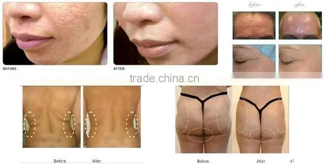 AYJ-T05 ayplus best home rf skin tightening face lifting machine