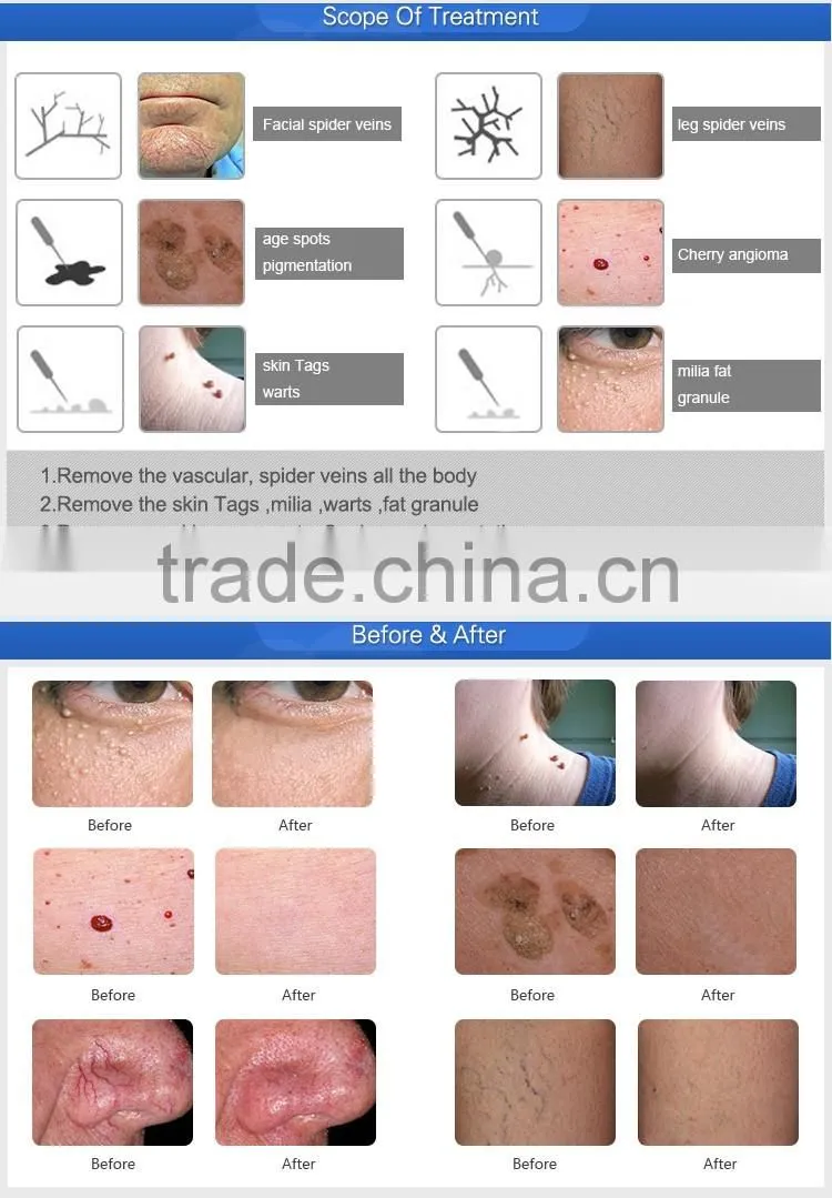 30MHz RBS beauty machine coagulation vessels laser blood vessel removal device