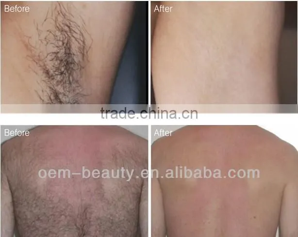 Dramatic changes permanent hair removal/onychomycosis therapy machine with long pulsed yag laser (CEapproval)for salon