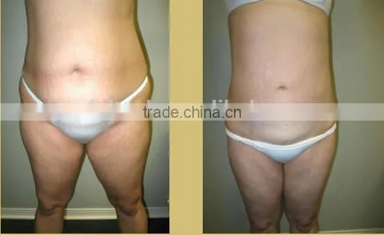 body cupping vacuum massage