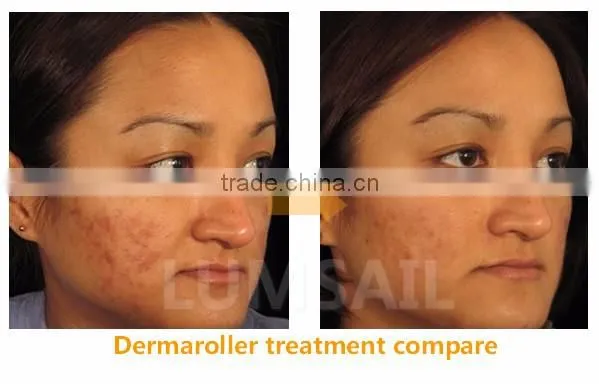 Skin care dermaroller derma roller titanium