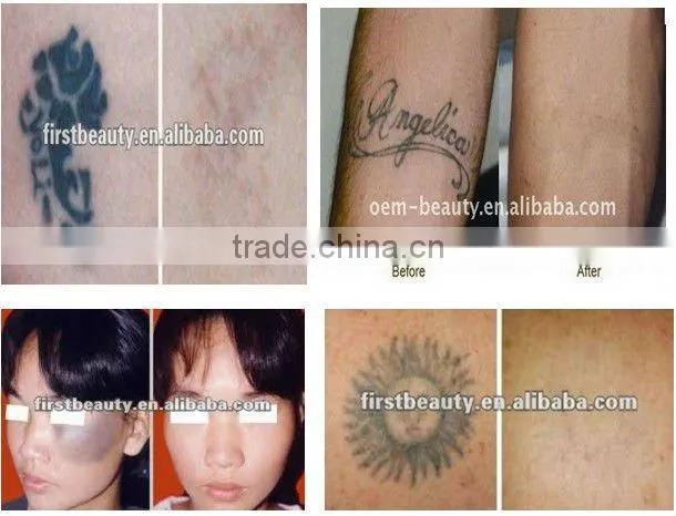 2012 newest protable laser tattoo removal machine D003