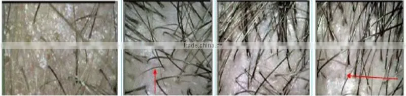 sanhe produced hair loss treatment hair regrowth machine for hair loss/fast hair growth treatment