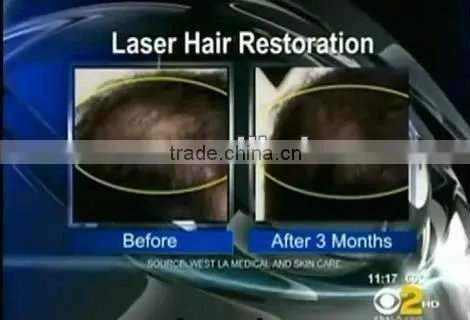400 laser diodes for hair regrowth machine from Vanoo companay