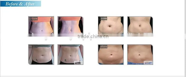 World most advanced professional HIFUSHAPE high intensity focused ultrasound hifu system for body slimming