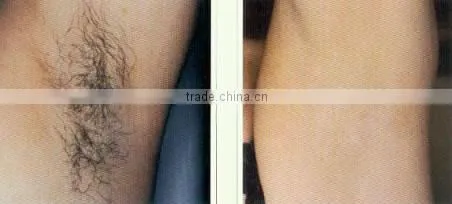 permanent hair removal laser (HS-280)