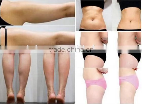 factory price multifunction liposonix hifu slimming machine