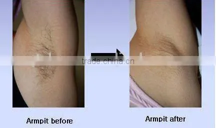 Lumenis Lightsheer Duet 808nm diode laser venus laser hair removal