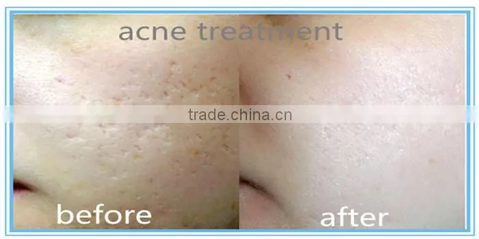 2940 erbium yag medical laser scar removal machine
