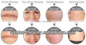 hot sale radio freuquency facial machine for anti-aging and slimming