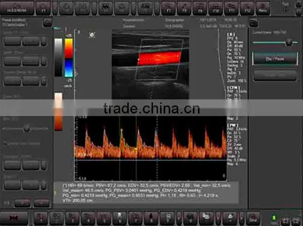 3D Color Doppler Ultrasound Machine with touch screen with competitive price MSLCU22-N