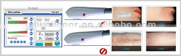 Top quality ywe-4 salon use hair removal beauty machine