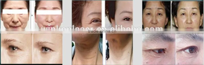 fractional rf / rf fractional micro needle / rf skin tightening machine