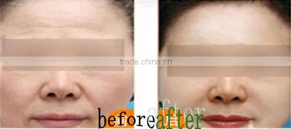 pretty lady salon product Wrinkle Removal Equipment
