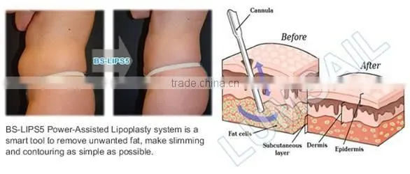 Surgery Beauty Machine Liposuction Fat Suction Machine