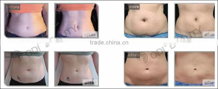 25%OFF! 2015 Supersonic fast weight loss hifu body shape OD-R100