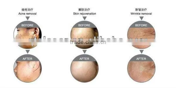 qts led pdt skin rejuvenation