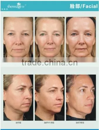AYJ-C19(CE) Dot matrix portable thermal rf beauty equipment fractionel