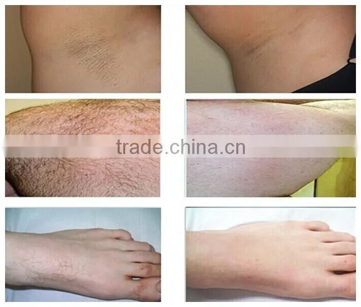 ipl hair removal electrolysis machine with CE approved