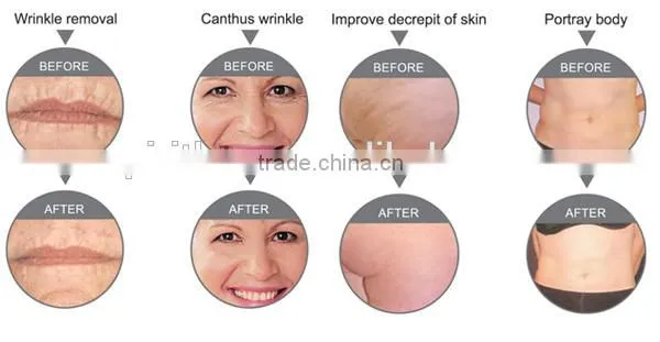 Best China High Quality RF Facial Machine