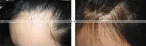 2015 Titanium galvanic derma roller microneedle L005 540 nm