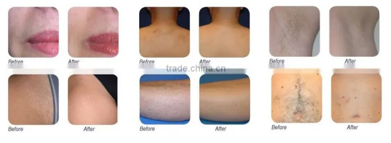 laser chips 600w 808nm hair removal for sale