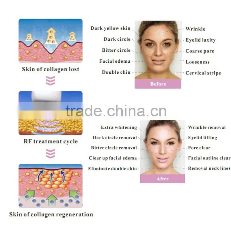 2014 As Seen As TV Face Liftiong Beauty Equipment Radio Frequency Machine Home