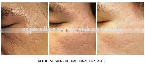 40W Mini RF Tube Fractional Co2 Laser