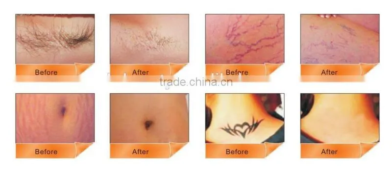 China Suppliers Hair Loss Treatment Nd Yag Laser Tattoo Removal Machine