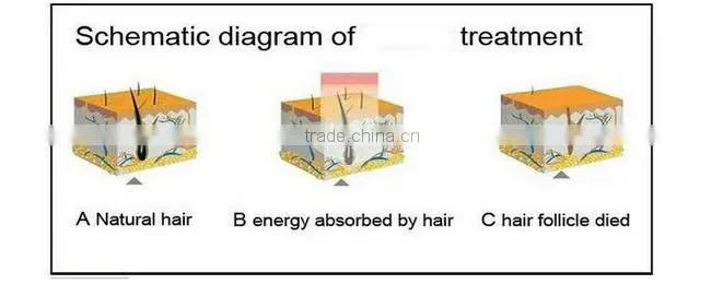 professional ipl hair removal machine/wrinkle removal beauty machine
