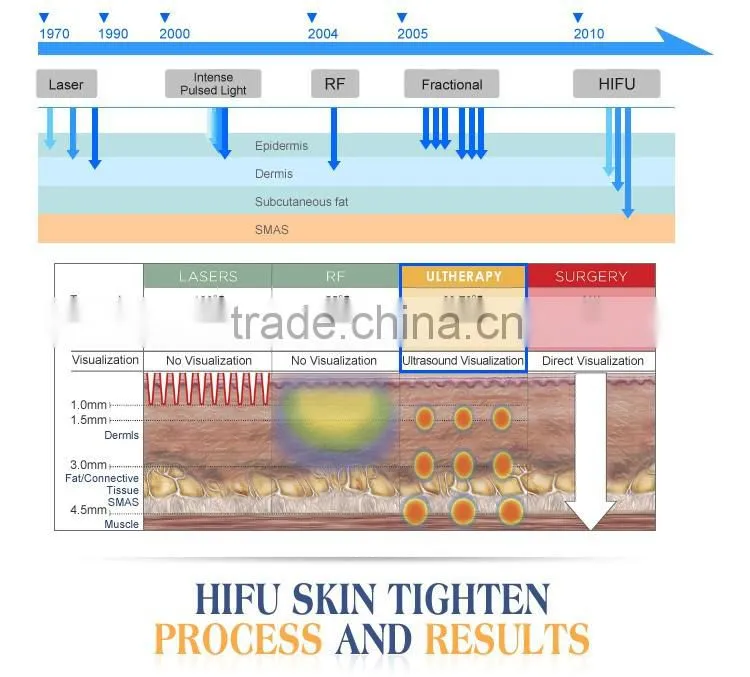 High Intensity Focused Ultrasound Hifu/ Hifu Anti-wrinkle With Amazing Effect