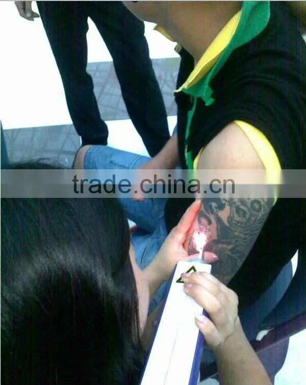 nd yag laser dark skin tattoo removal/mini q switched nd yag laser tattoo removal machin/nd yag laser